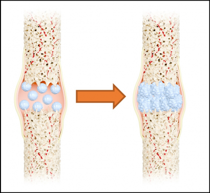 「納米仿天然骨」材料接近人類骨頭，具高彈性、高韌性和高強度。此物料可提供穩固支撐並促進骨骼癒合。
 